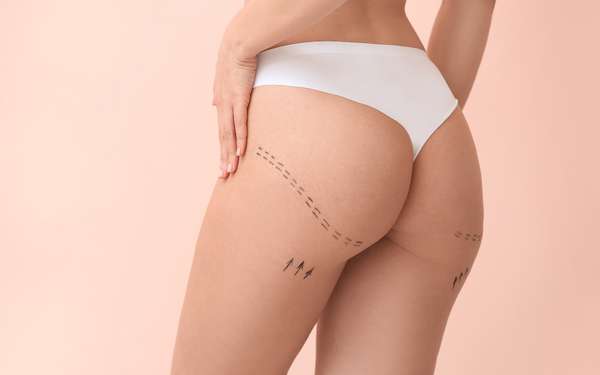 Brazilian Butt Lift